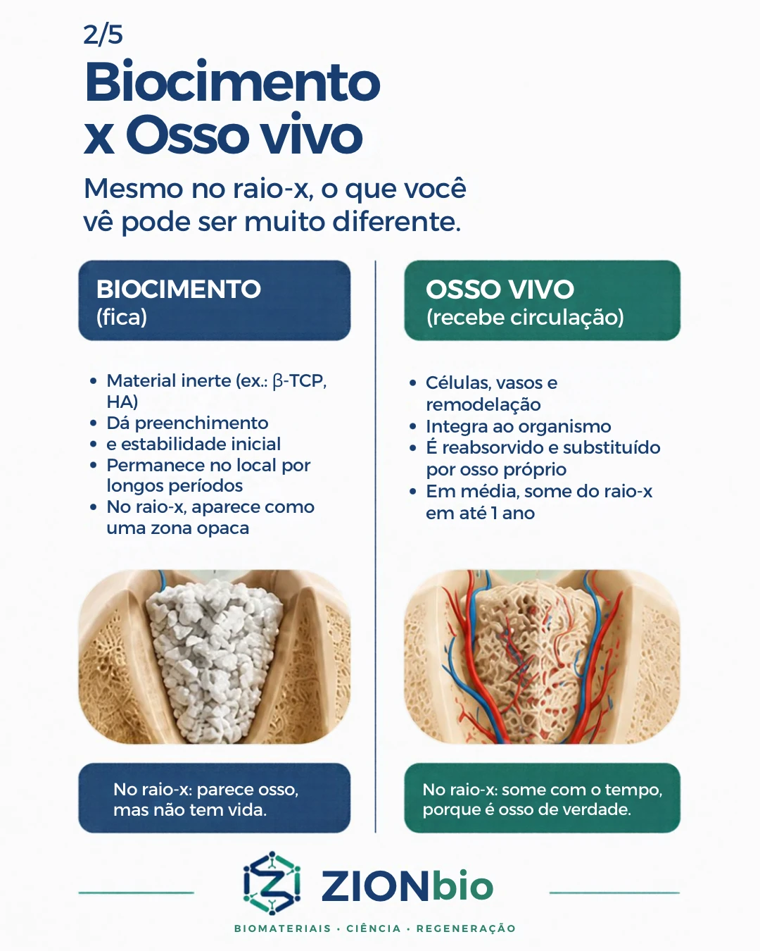 Biocimento x osso vivo - comparativo enxerto osseo odontologico ZionBio