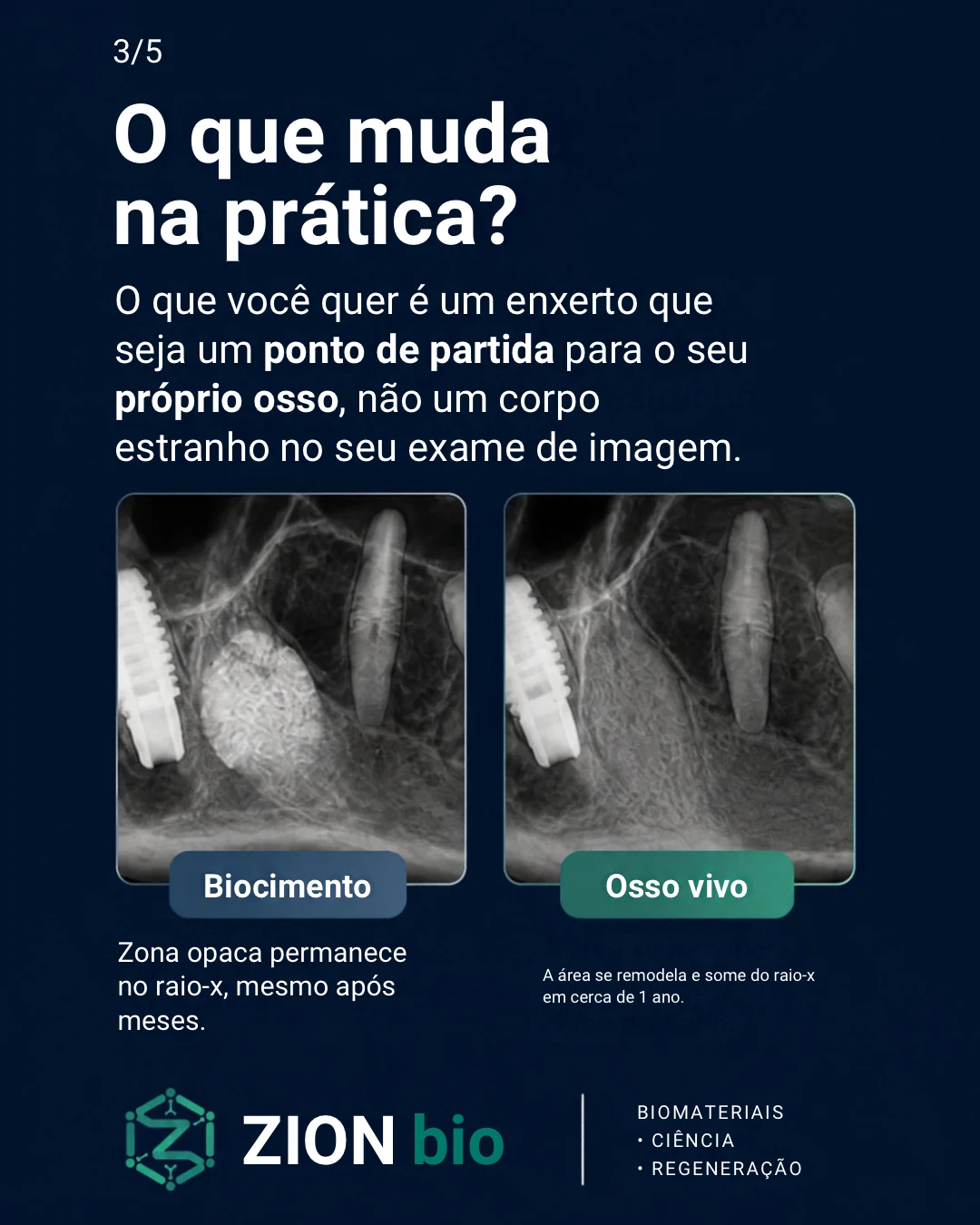 O que muda na pratica - enxerto osseo odontologico Blue Bone ZionBio