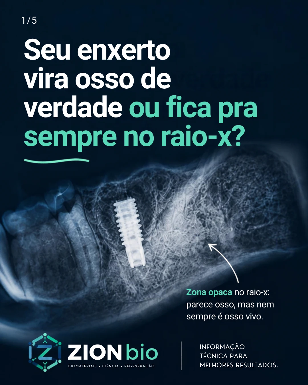 Raio-x enxerto osseo odontologico - biocimento x osso vivo ZionBio