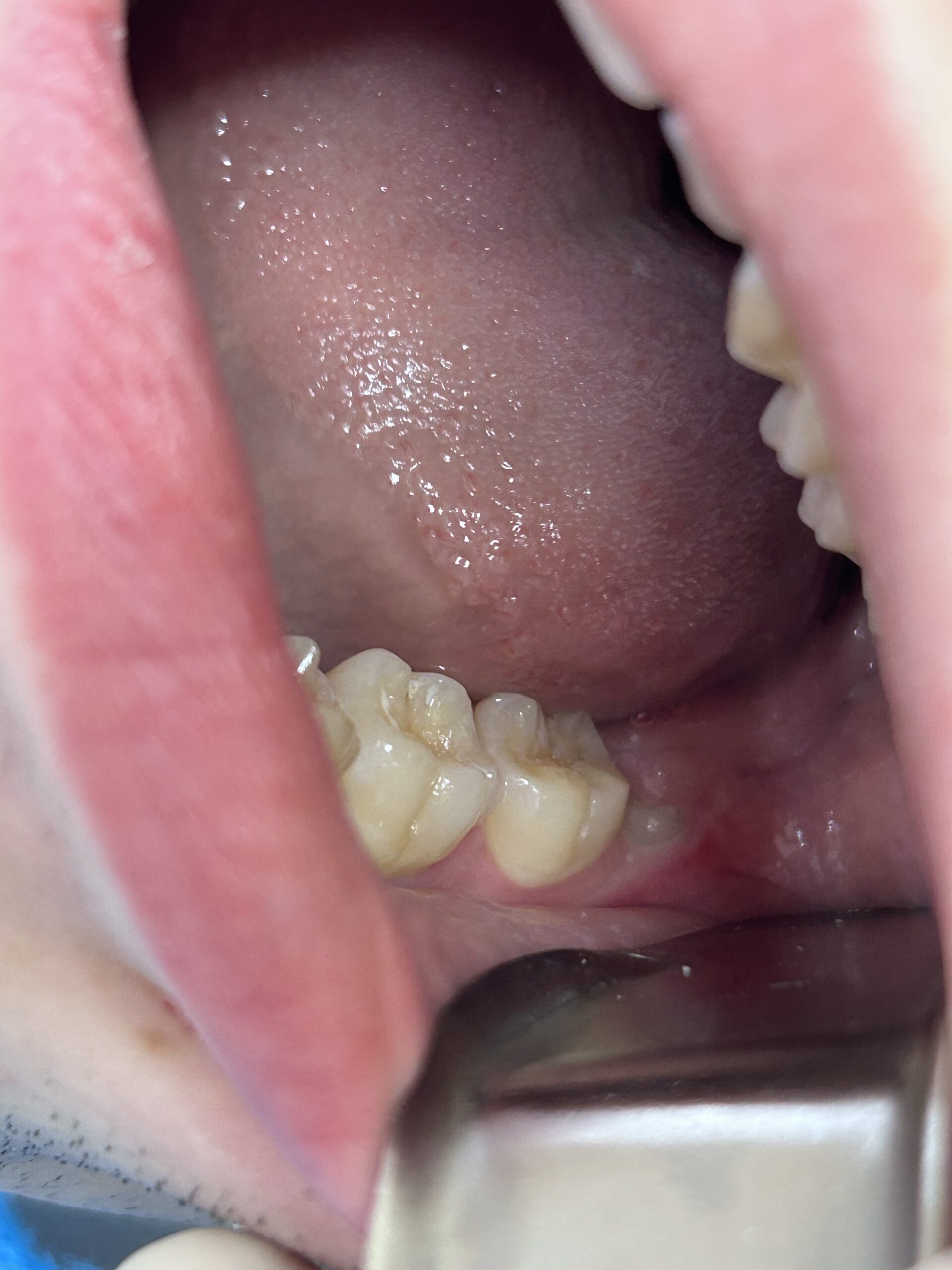Caso clinico real antes - preservacao alveolar enxerto osseo odontologico ZionBio