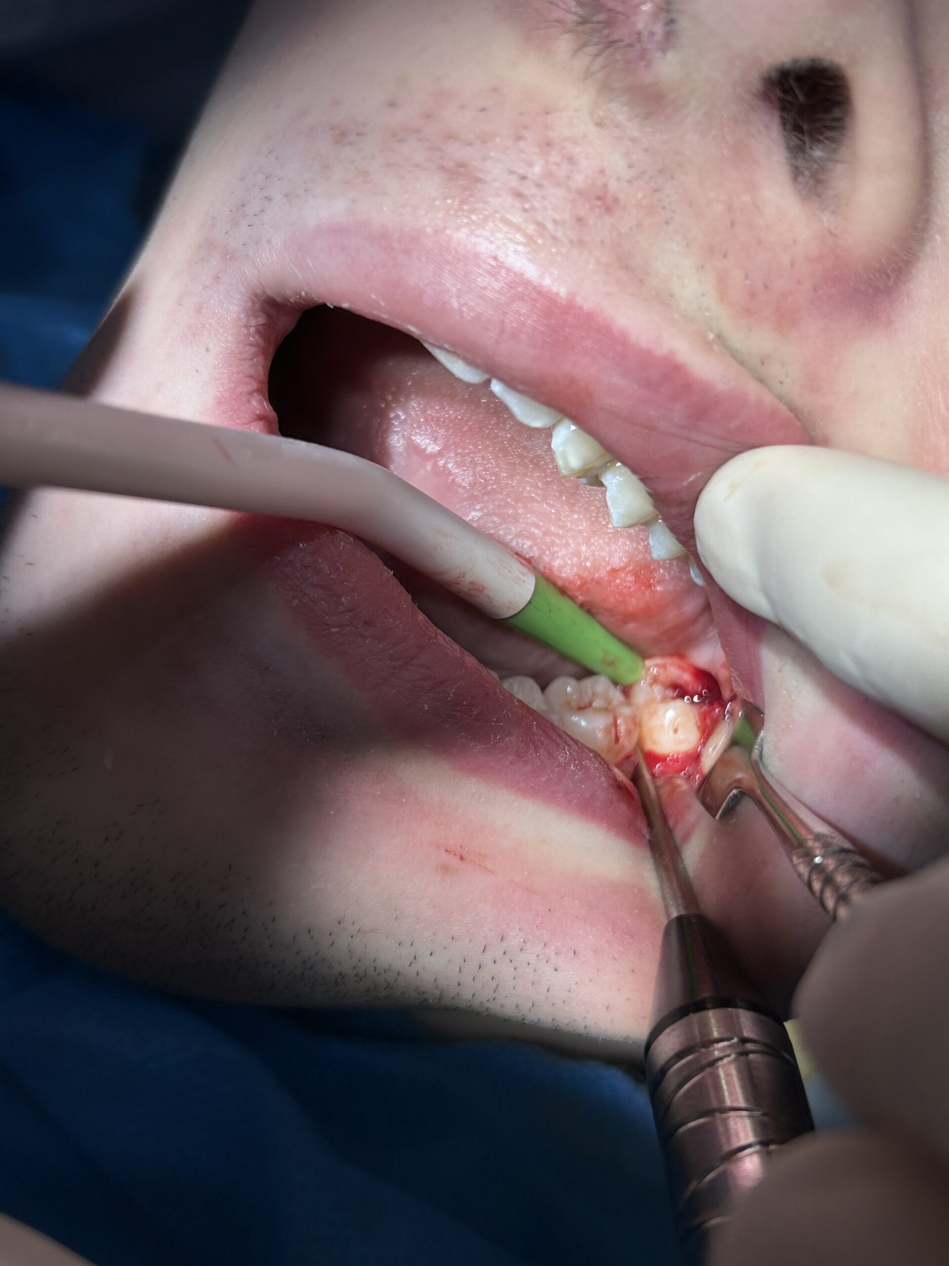 Exodontia - extracao do dente, caso clinico real ZionBio