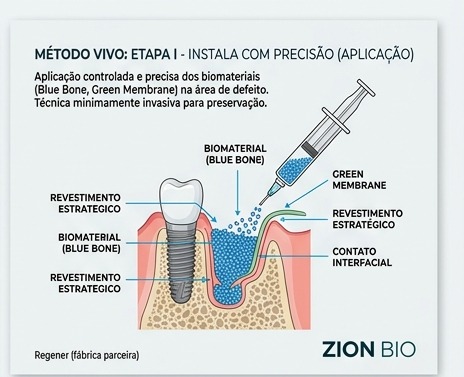 Metodo VIVO - instala com precisao - enxerto osseo odontologico Blue Bone