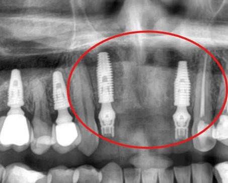 Radiografias de regeneração óssea com Blue Bone (imagem 1)