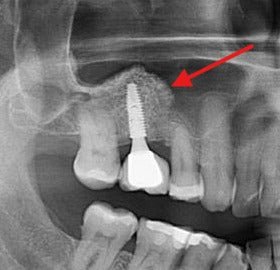 Radiografias de regeneração óssea com Blue Bone (imagem 2)