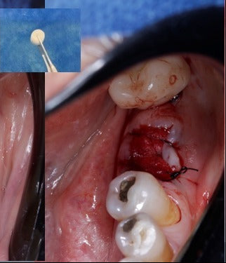 Preservação alveolar com Green Membrane CAP (imagem 1)