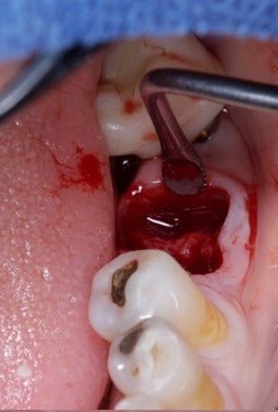 Preservação alveolar com Green Membrane CAP (imagem 2)