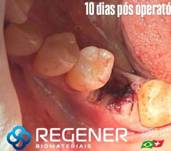 Estabilização do coágulo após exodontia (imagem 1)