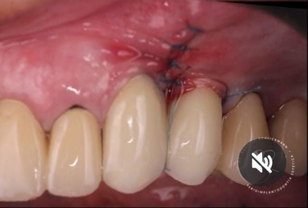 Espessamento de tecido mole peri-implantar com Membrana Perio (imagem 1)