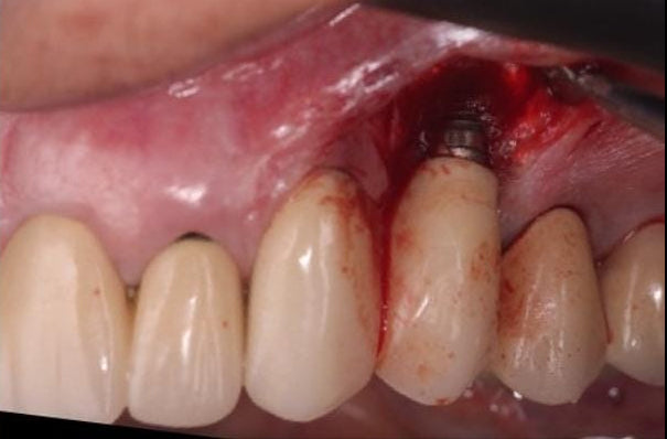 Espessamento de tecido mole peri-implantar com Membrana Perio (imagem 2)